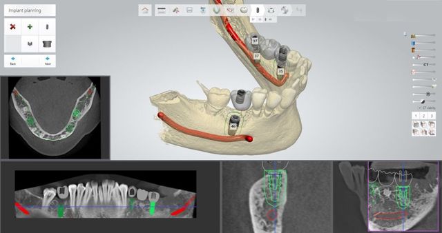 Diagnostic et implant dentaire Beauchamp Horizon sourire