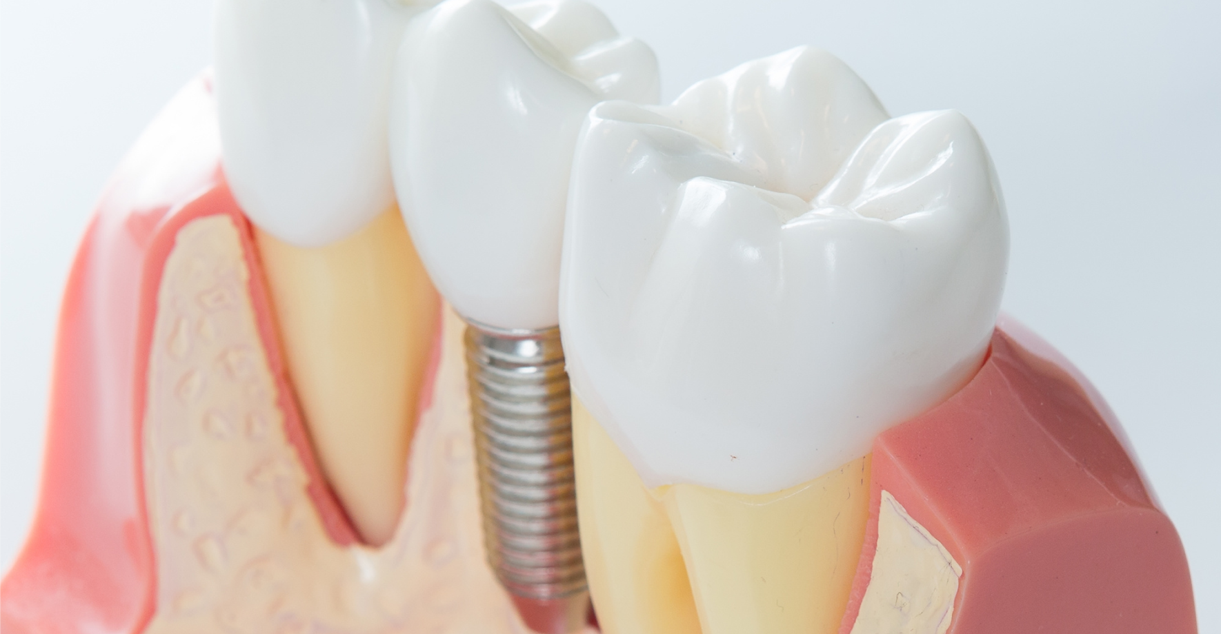 implant dentaire beauchamp