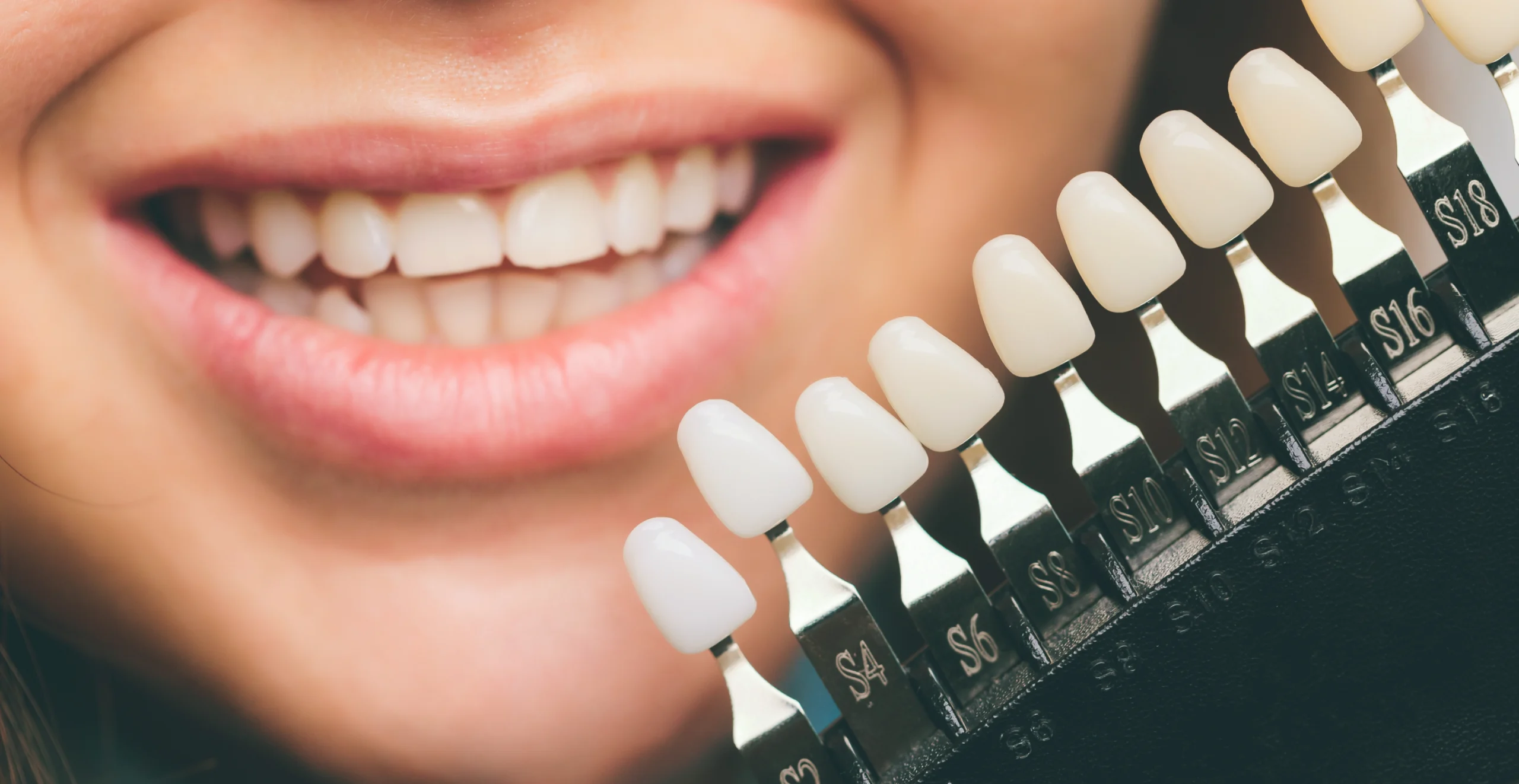 dentiste saint leu la foret rehabilitation esthetique scaled Facettes Horizon Sourire | Chirurgiens-dentistes Beauchamp