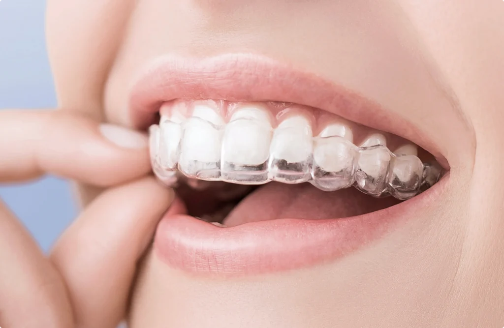 dentiste saint prix eln nocturne Contention Horizon Sourire | Chirurgiens-dentistes Beauchamp