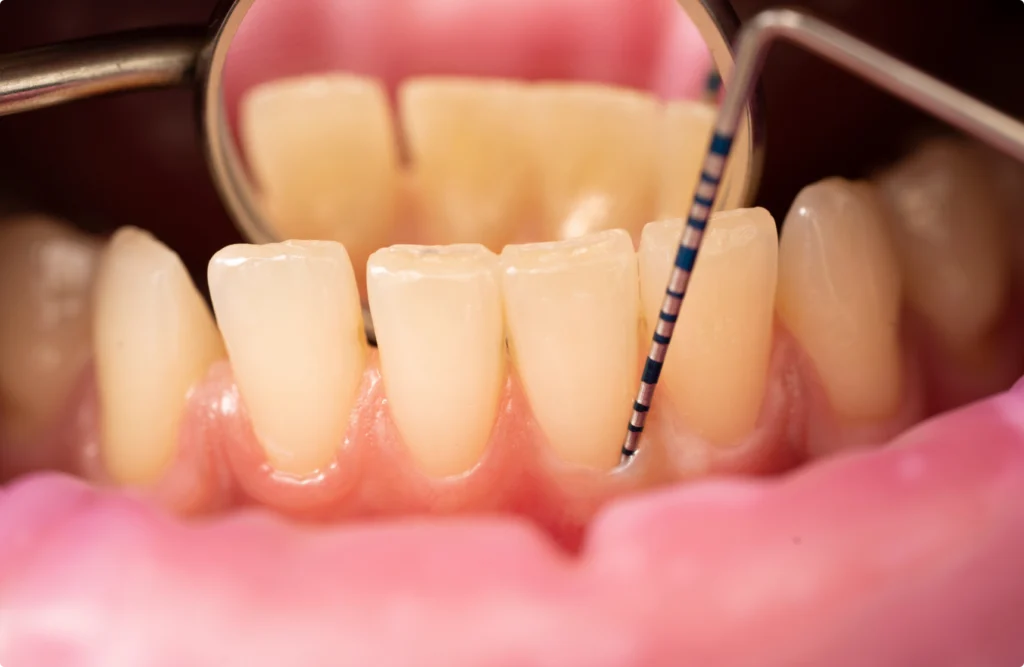 ecrans buccaux taverny ecrans buccaux taverny Détartrage Horizon Sourire | Chirurgiens-dentistes Beauchamp