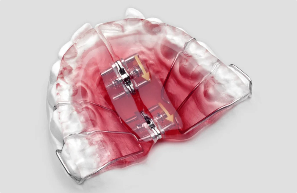 appareils orthodontiques disjoncteur palatin appareils orthodontiques disjoncteur palatin Appareils orthodontiques Horizon Sourire | Chirurgiens-dentistes Beauchamp