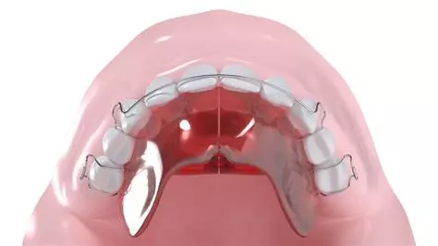 appareils orthodontiques enfant adolescent appareils orthodontiques enfant adolescent Appareils orthodontiques Horizon Sourire | Chirurgiens-dentistes Beauchamp