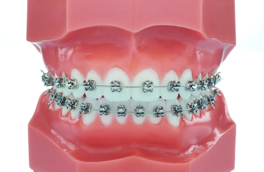 appareils orthodontiques horizon sourire appareils orthodontiques horizon sourire Appareils orthodontiques Horizon Sourire | Chirurgiens-dentistes Beauchamp