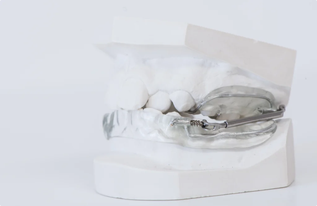 appareils orthodontiques quad helix appareils orthodontiques quad helix Appareils orthodontiques Horizon Sourire | Chirurgiens-dentistes Beauchamp