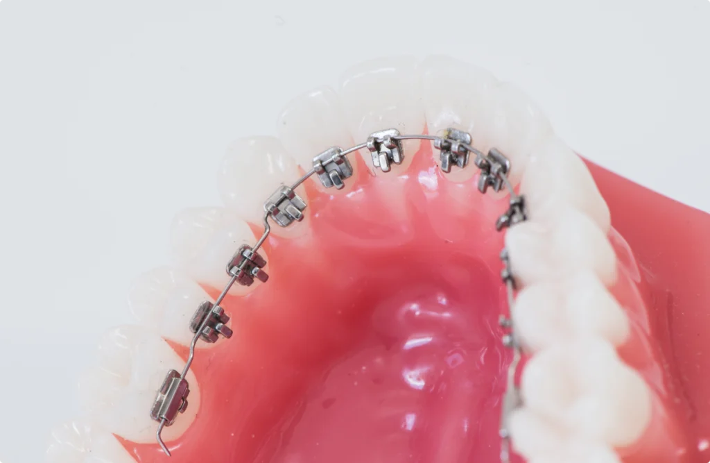 appareils orthodontiques saint leu appareils orthodontiques saint leu Appareils orthodontiques Horizon Sourire | Chirurgiens-dentistes Beauchamp