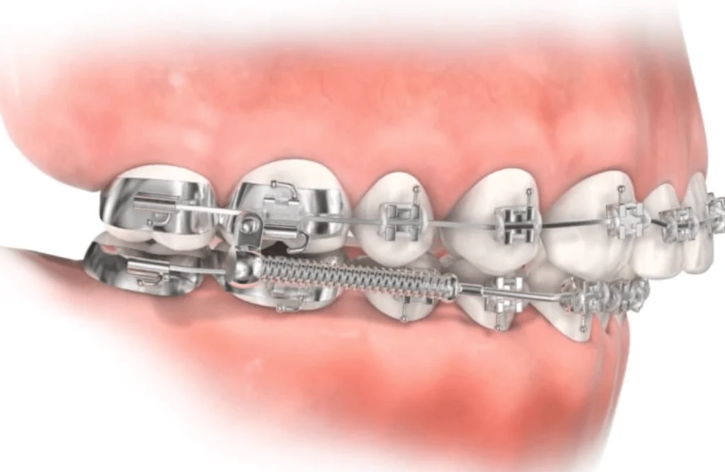 cabinet horizon sourire implants dentaires cabinet horizon sourire implants dentaires Appareils orthodontiques Horizon Sourire | Chirurgiens-dentistes Beauchamp